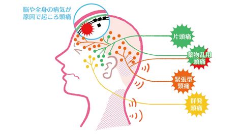 頭頂頭痛 原因|頭痛の種類まとめ～それぞれの違いと原因、症状、治。